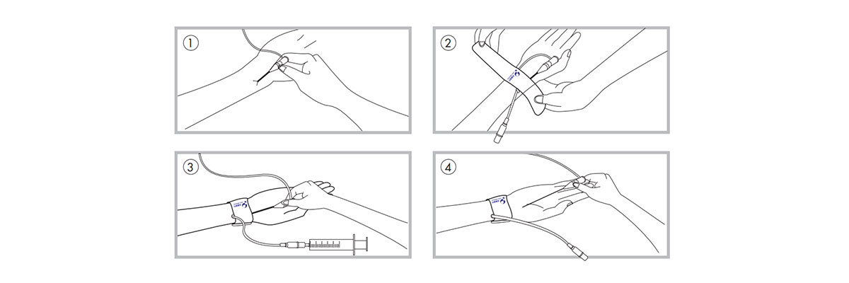 Rayband™ Radial Artery Compression Tourniquet